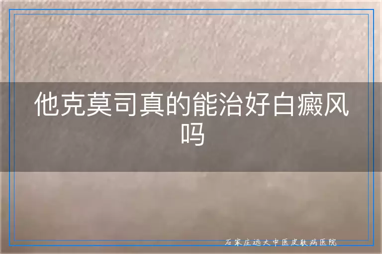 他克莫司真的能治好白癜风吗