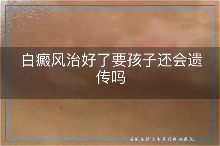 白癜风治好了要孩子还会遗传吗