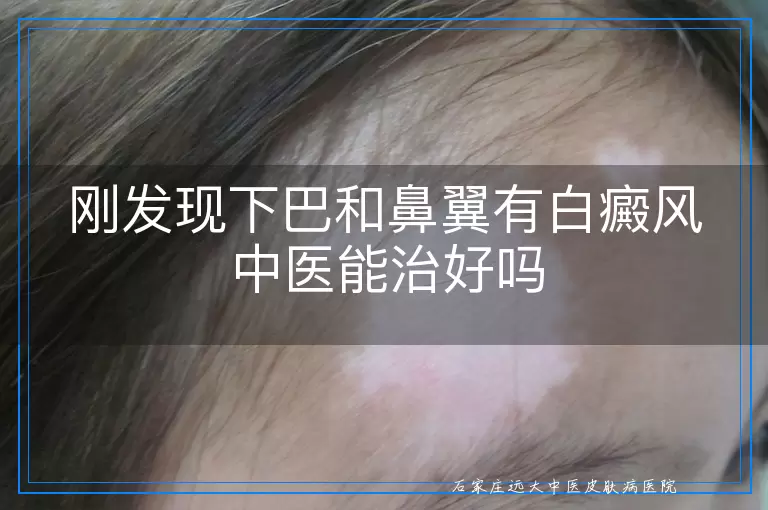 刚发现下巴和鼻翼有白癜风中医能治好吗