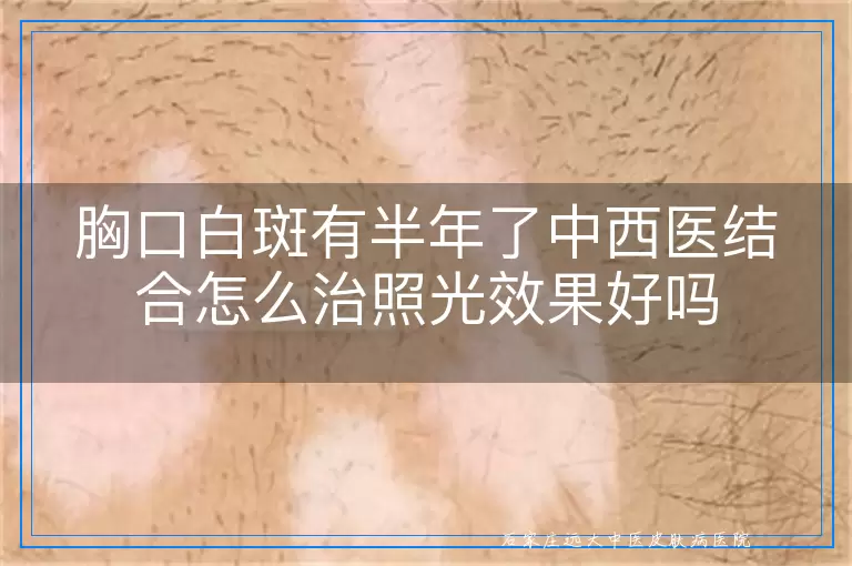胸口白斑有半年了中西医结合怎么治照光效果好吗