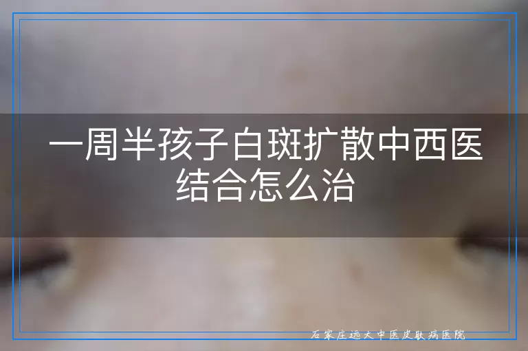 一周半孩子白斑扩散中西医结合怎么治