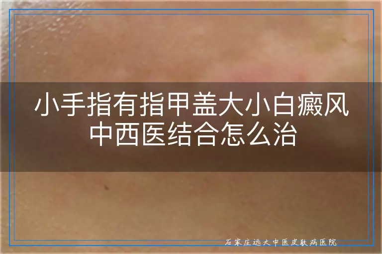 小手指有指甲盖大小白癜风中西医结合怎么治