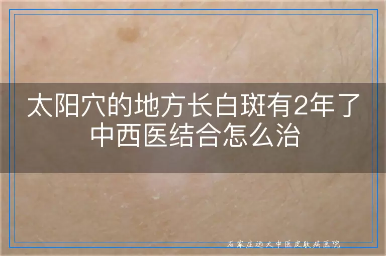 太阳穴的地方长白斑有2年了中西医结合怎么治