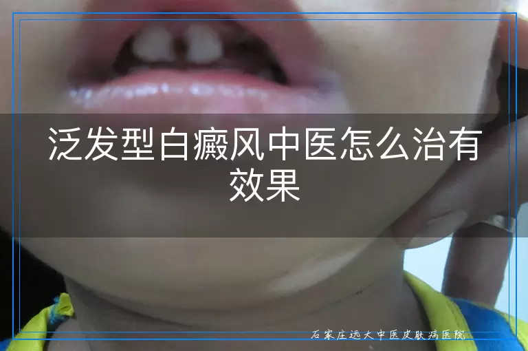 泛发型白癜风中医怎么治有效果