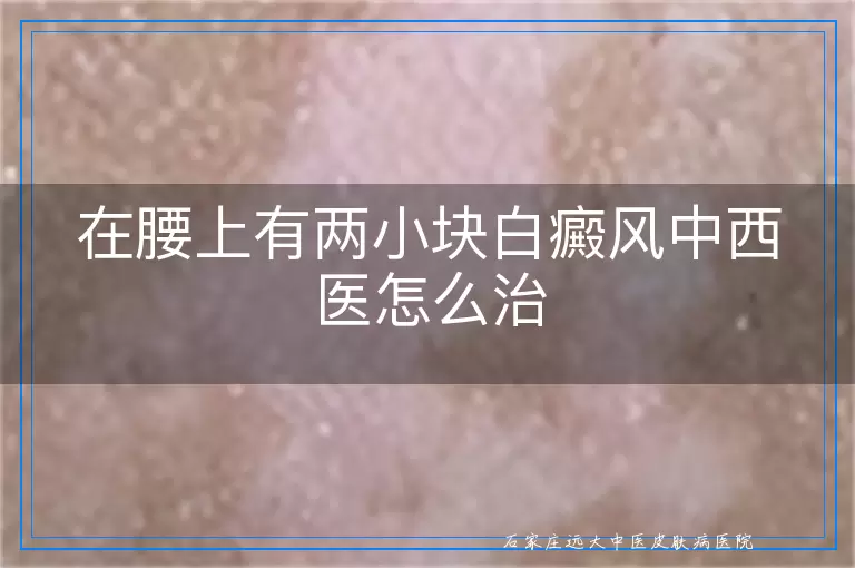 在腰上有两小块白癜风中西医怎么治