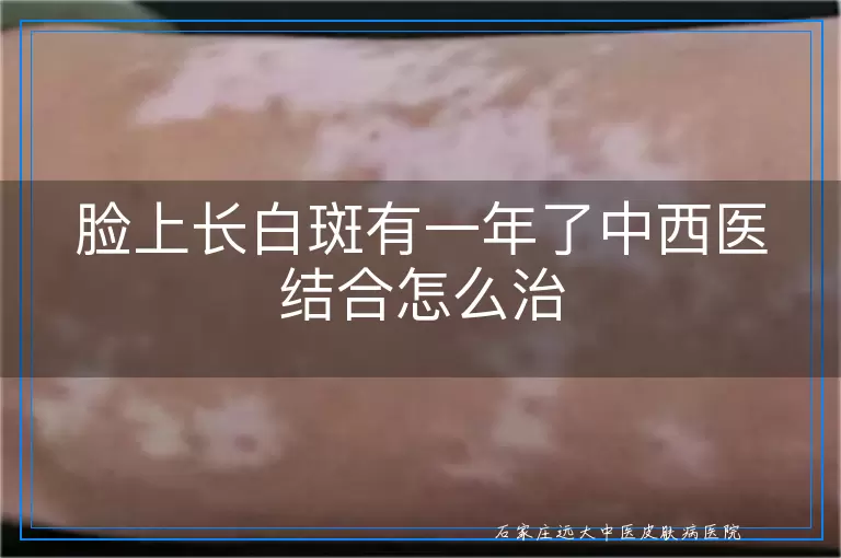 脸上长白斑有一年了中西医结合怎么治