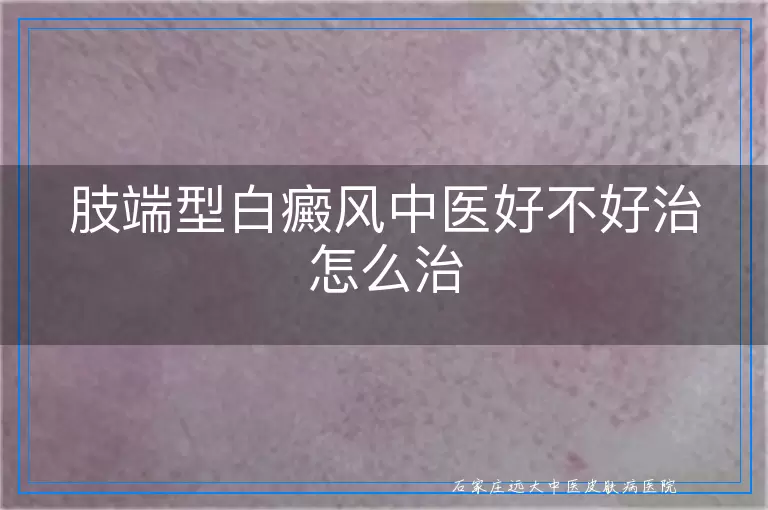 肢端型白癜风中医好不好治怎么治