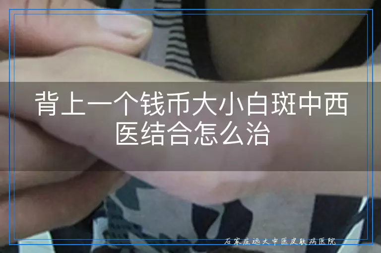 背上一个钱币大小白斑中西医结合怎么治
