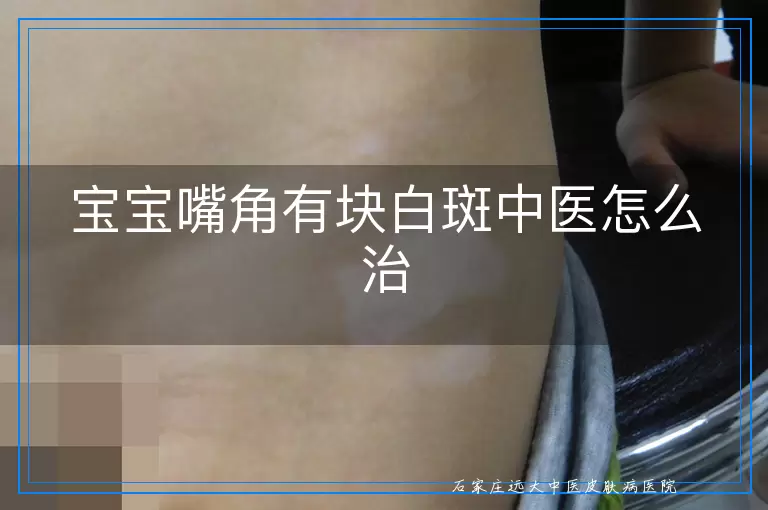 宝宝嘴角有块白斑中医怎么治