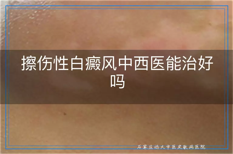 擦伤性白癜风中西医能治好吗
