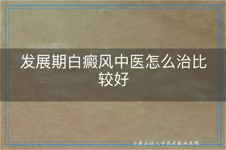 发展期白癜风中医怎么治比较好