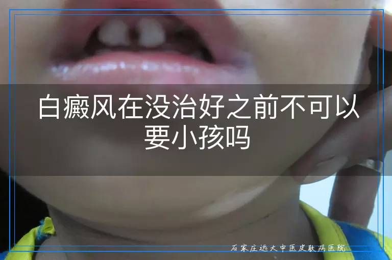 白癜风在没治好之前不可以要小孩吗