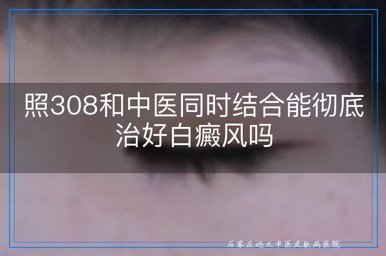 照308和中医同时结合能彻底治好白癜风吗