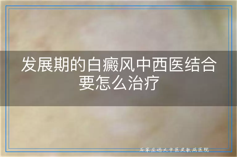 发展期的白癜风中西医结合要怎么治疗