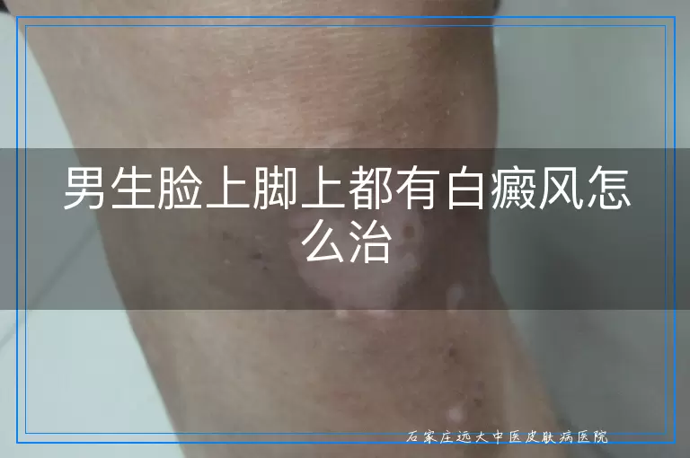 男生脸上脚上都有白癜风怎么治