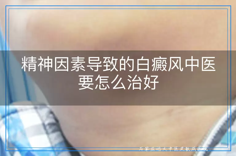 精神因素导致的白癜风中医要怎么治好