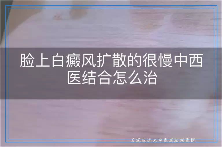 脸上白癜风扩散的很慢中西医结合怎么治