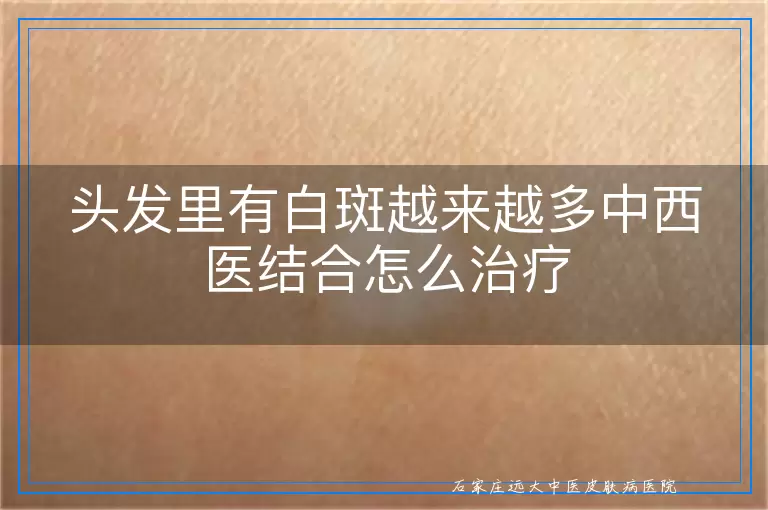 头发里有白斑越来越多中西医结合怎么治疗