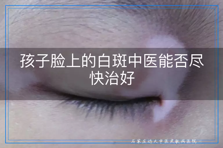 孩子脸上的白斑中医能否尽快治好