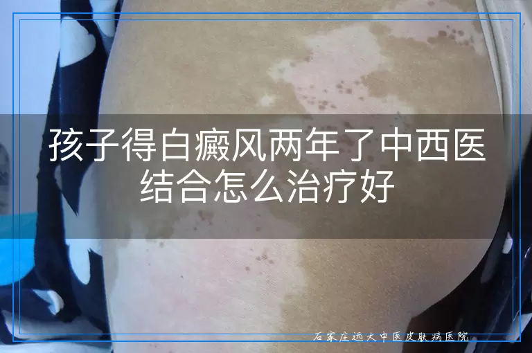 孩子得白癜风两年了中西医结合怎么治疗好