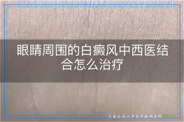 眼睛周围的白癜风中西医结合怎么治疗