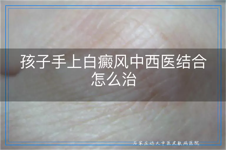 孩子手上白癜风中西医结合怎么治
