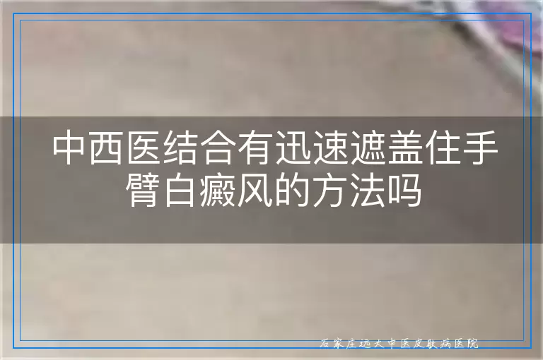 中西医结合有迅速遮盖住手臂白癜风的方法吗