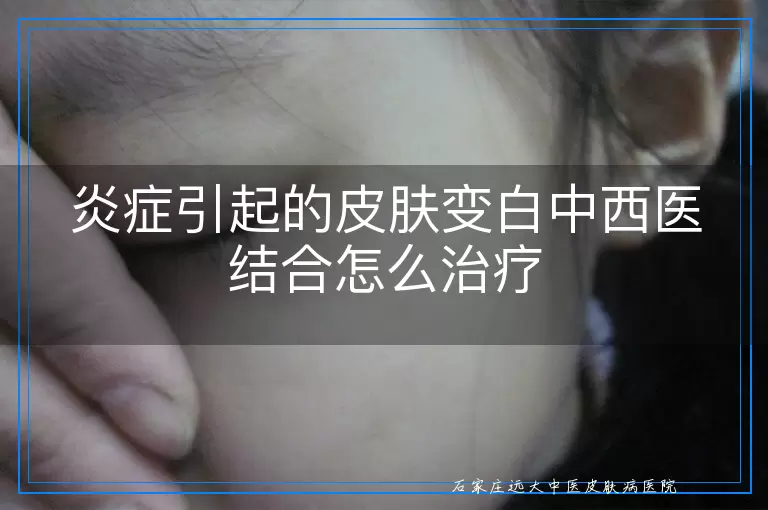 炎症引起的皮肤变白中西医结合怎么治疗