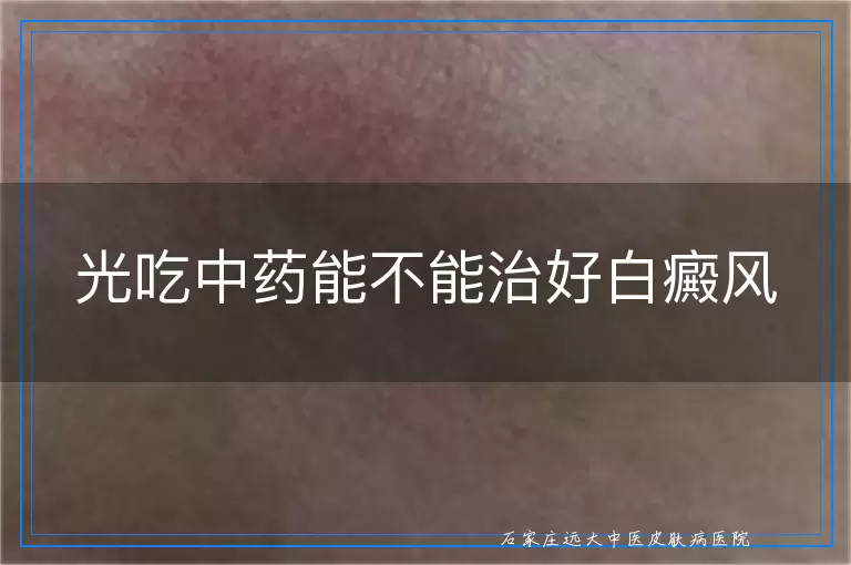 光吃中药能不能治好白癜风