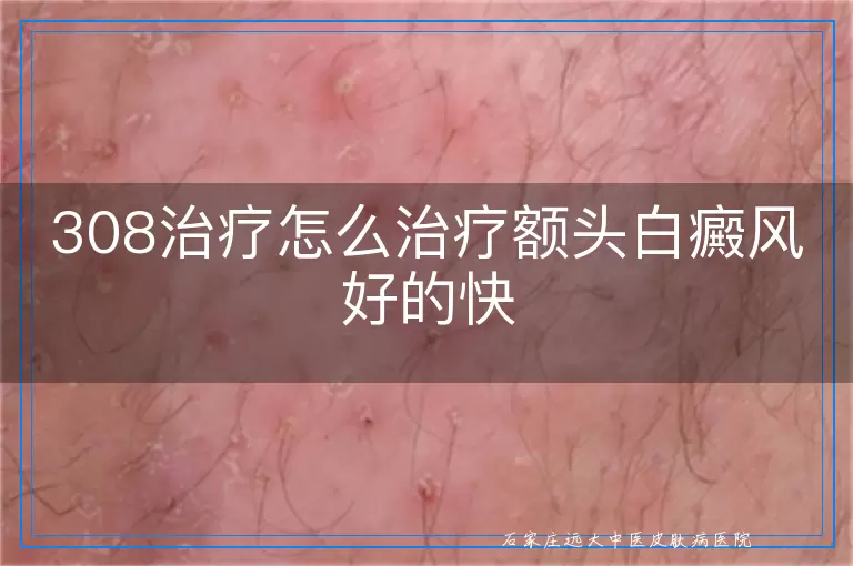 308治疗怎么治疗额头白癜风好的快