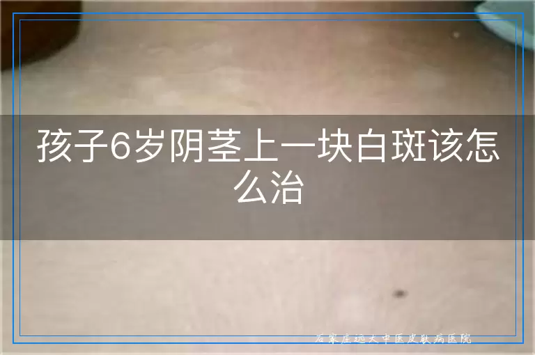 孩子6岁阴茎上一块白斑该怎么治