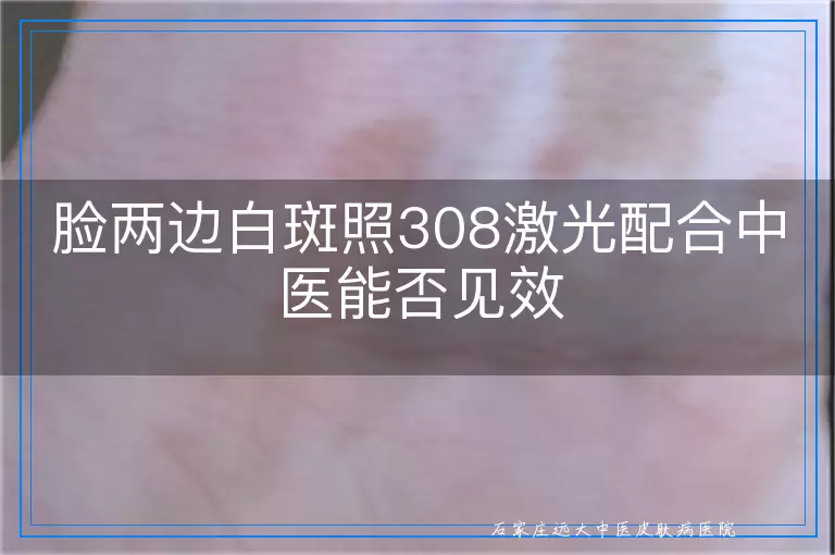 脸两边白斑照308激光配合中医能否见效