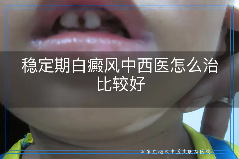 稳定期白癜风中西医怎么治比较好