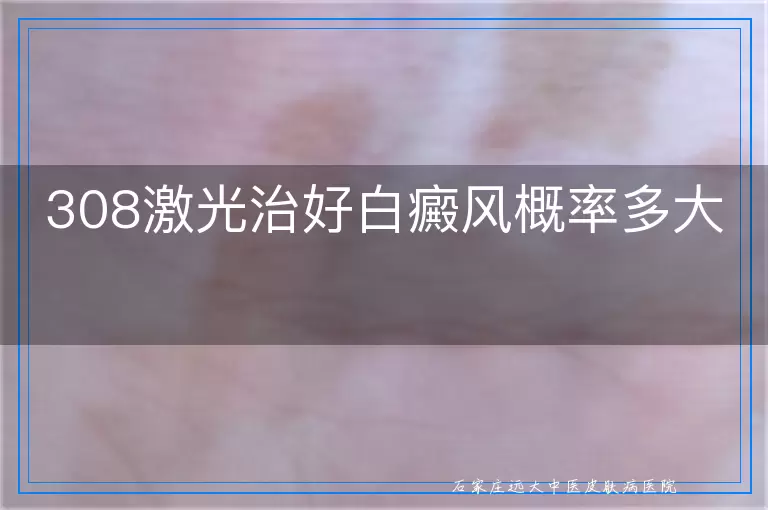 308激光治好白癜风概率多大