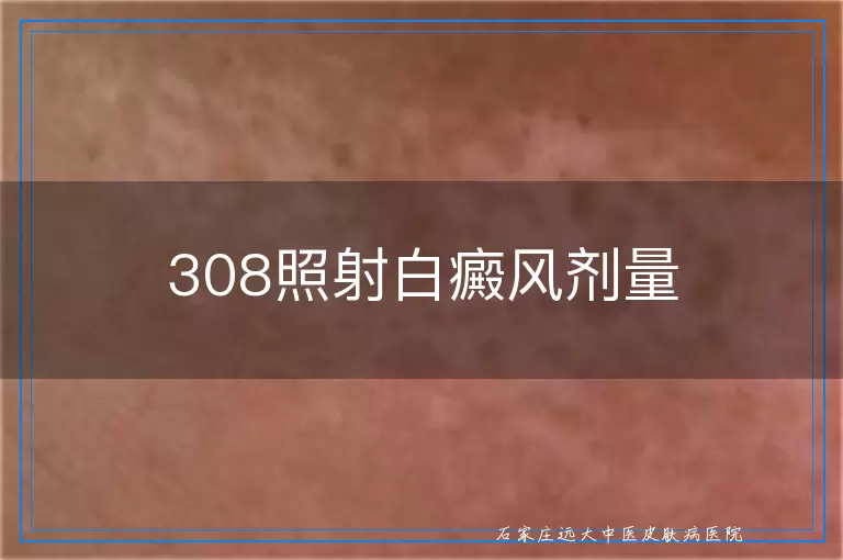 308照射白癜风剂量