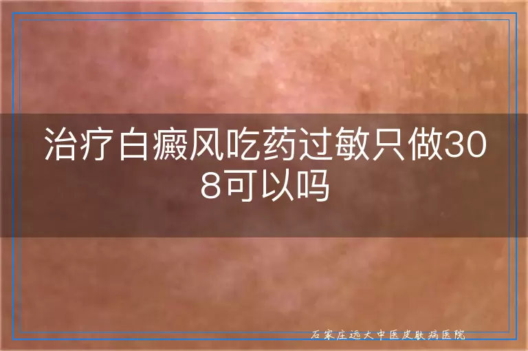 治疗白癜风吃药过敏只做308可以吗
