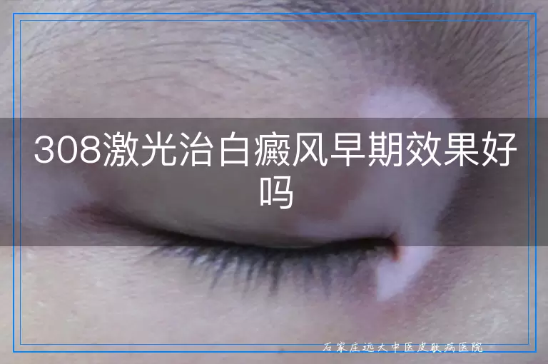 308激光治白癜风早期效果好吗