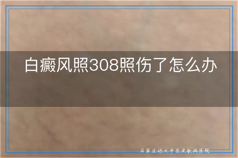 白癜风照308照伤了怎么办