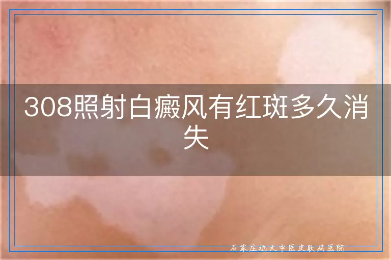 308照射白癜风有红斑多久消失