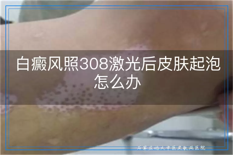 白癜风照308激光后皮肤起泡怎么办
