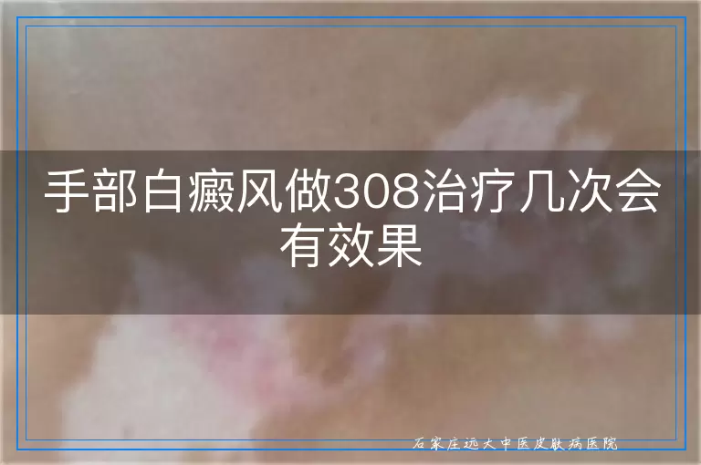手部白癜风做308治疗几次会有效果