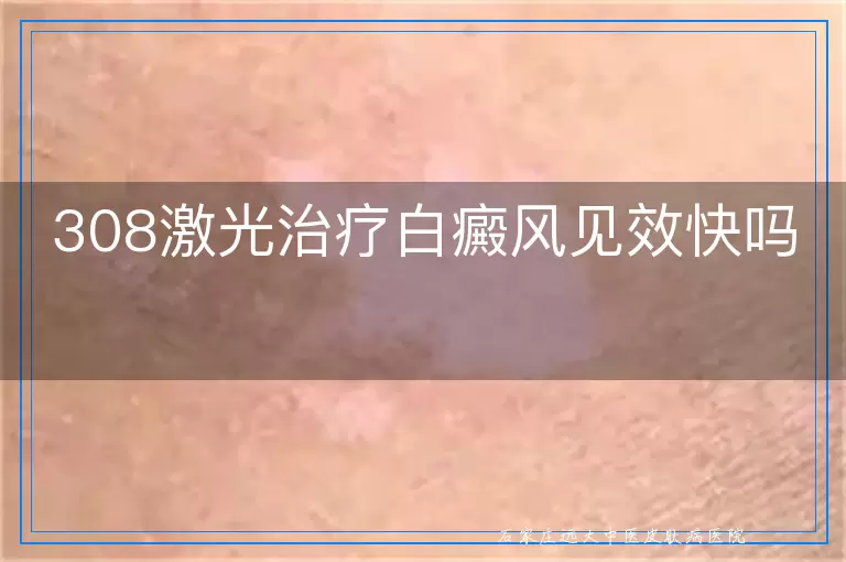 308激光治疗白癜风见效快吗