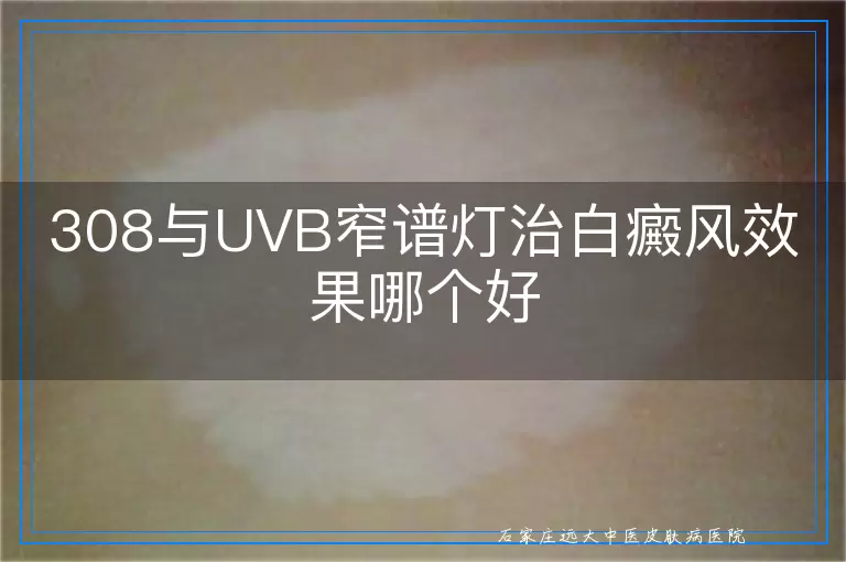 308与UVB窄谱灯治白癜风效果哪个好