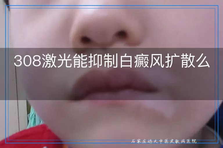 308激光能抑制白癜风扩散么