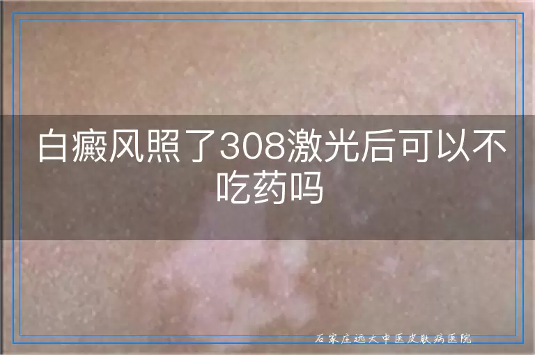 白癜风照了308激光后可以不吃药吗