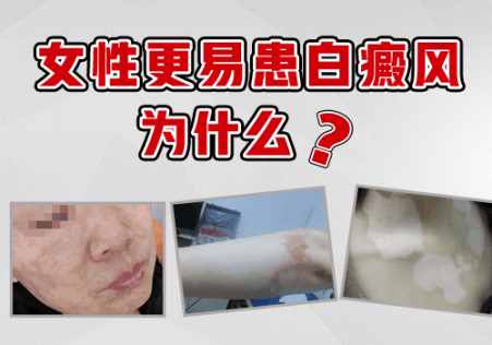 逐渐变大的白癜风照美国308激光效果好不好