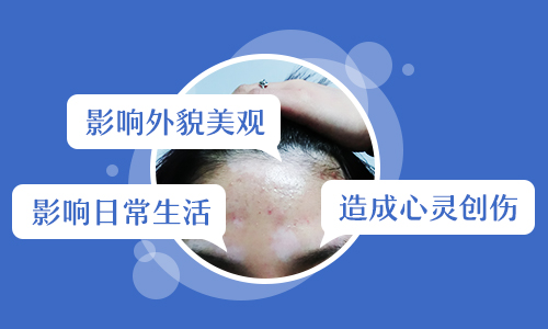 白癜风吃药没控制住还有什么好办法