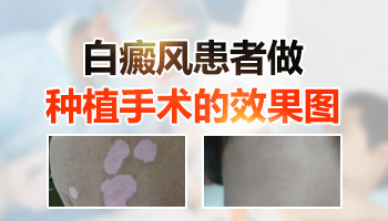 儿童面部有白斑在变大该怎么办