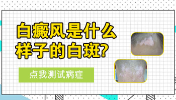 孩子身上长白点照UVB能治得好吗
