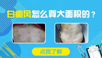 儿童肩膀巴掌大白斑只照308激光能控制住吗